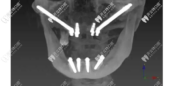 穿翼種植牙示意圖