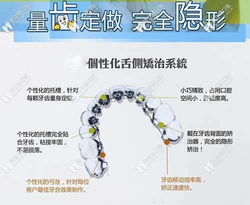 舌側(cè)矯正技術(shù) 舌側(cè)矯正技術(shù)