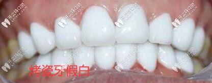 烤瓷牙假白圖片