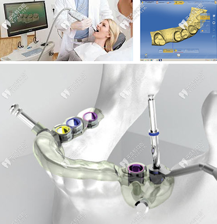 數(shù)字化種植牙