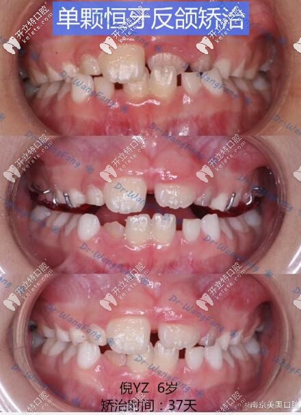 孩子恒牙反頜ETA早期矯治37天效果驚人,雖然價格比mrc貴