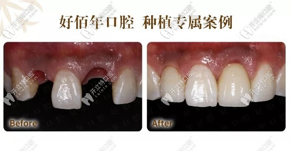 好佰年口腔種植牙案例