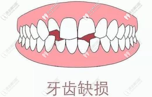 上門牙缺了一小塊別慌,來看看下我做的全瓷冠修復效果咋樣