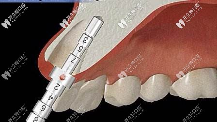 即刻種植對骨量是有一定要求的