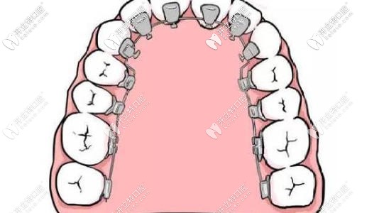 舌側(cè)矯正對(duì)醫(yī)生要求更多 舌側(cè)矯正對(duì)醫(yī)生要求更多