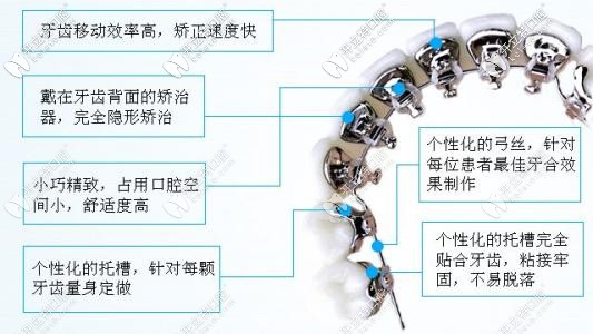 舌側(cè)矯正優(yōu)勢(shì) 舌側(cè)矯正優(yōu)勢(shì)