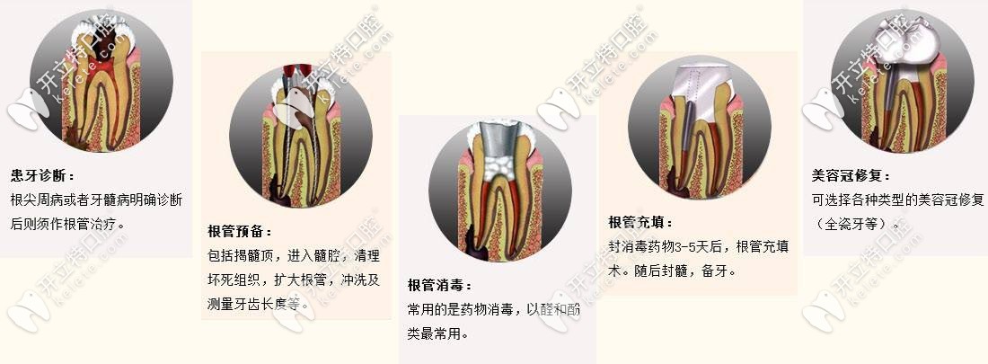 根管治療過程示意圖