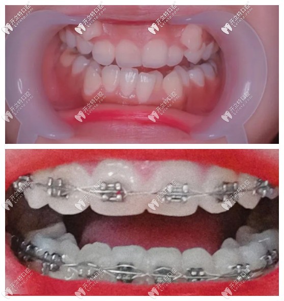 虎牙外凸很難矯正?聽說她戴damon自鎖牙套5個月虎牙被拉正了