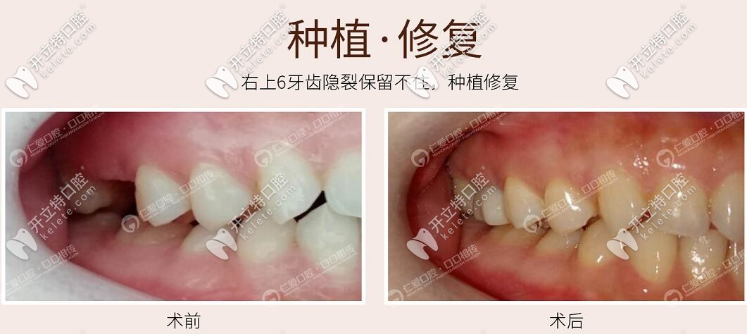 牙齒隱裂害我花了1萬多做了法國安卓健種植牙,30+就有假牙了