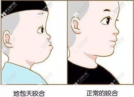 兒童地包天和正常的咬合對(duì)比