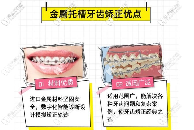 金屬矯正的優(yōu)勢(shì)