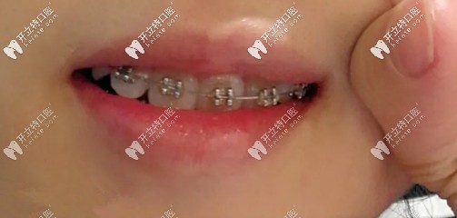 矯正虎牙多久能拉下來？我用了不到半年哦