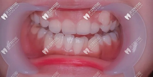 矯正前虎牙外凸的照片