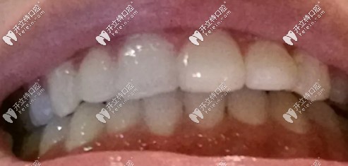 摘到牙套戴保持器，有點深覆合的人很漂亮哦