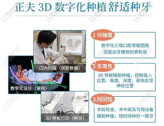 深圳正夫口腔數(shù)字化3D導板種植牙