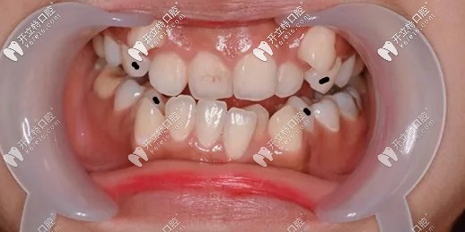 標(biāo)黑點的地方就是要拔掉的4顆4號牙