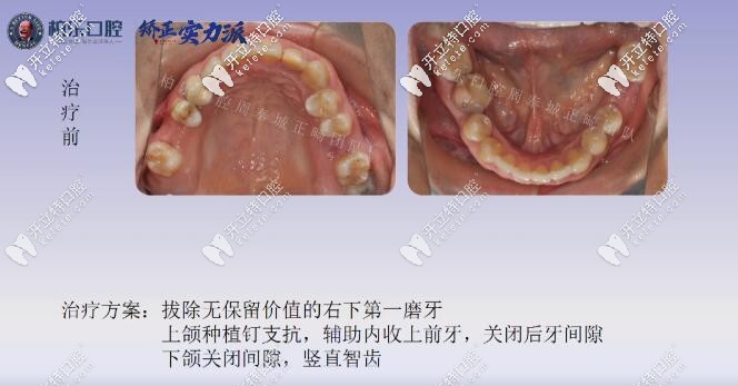 南寧柏樂(lè)口腔缺失三顆矯正方案