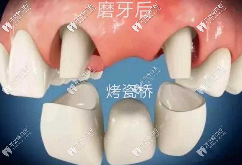 缺牙修復(fù)烤瓷橋