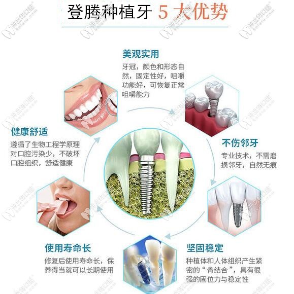 深圳正夫口腔韓國登騰種植牙優(yōu)勢
