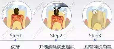 根管治療的意義 根管治療的意義
