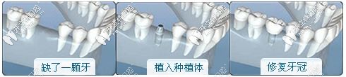 種植牙過程 種植牙過程