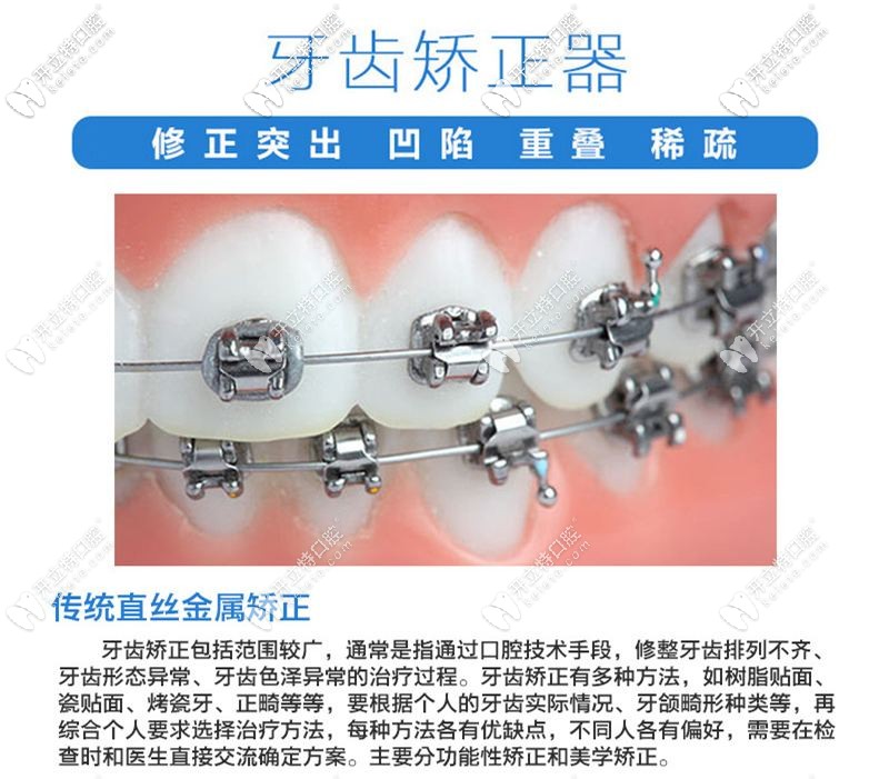 傳統(tǒng)牙齒矯正 傳統(tǒng)牙齒矯正