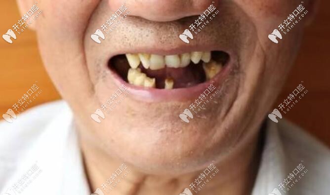 孫玉楓說70、80歲老人種牙好還是鑲牙好