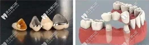 固定義齒 固定義齒