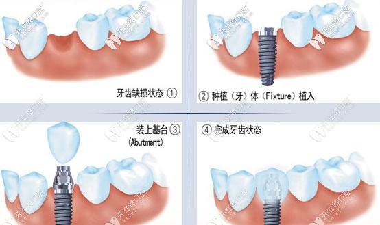 種植牙操作過(guò)程
