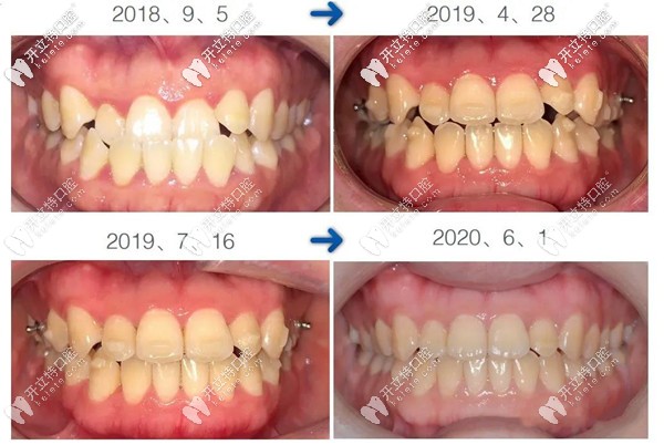 地包天在深圳韋博口腔做矯正前后對(duì)比照片 地包天在深圳韋博口腔做矯正前后對(duì)比照片
