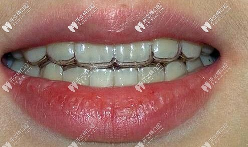 無錫美奧口腔顧客戴隱形牙套口內(nèi)照片 無錫美奧口腔顧客戴隱形牙套口內(nèi)照片