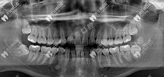 18歲牙齒矯正前X線片圖片 18歲牙齒矯正前X線片圖片