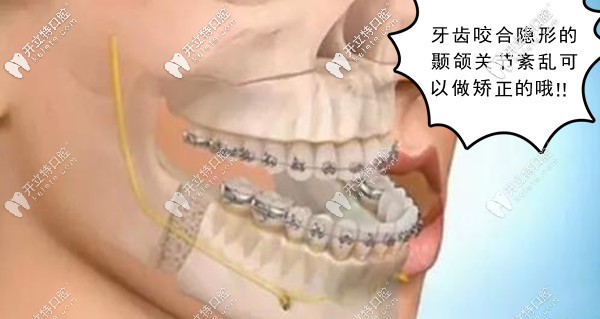 顳下頜關(guān)節(jié)紊亂能做牙齒矯正嗎