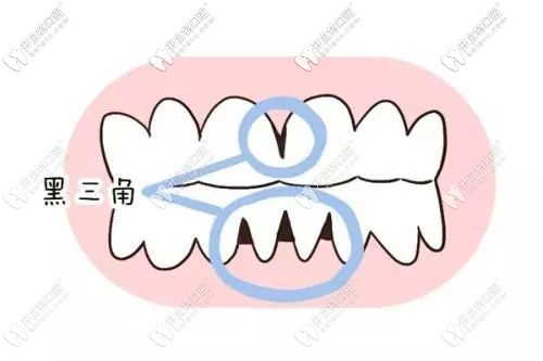 擔(dān)心牙齦萎縮不能做矯正?來(lái)看看我的牙齒矯正效果吧