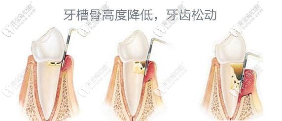 牙周炎會(huì)導(dǎo)致牙齒松動(dòng)