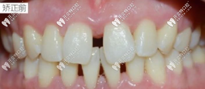 矯正前的牙齒情況