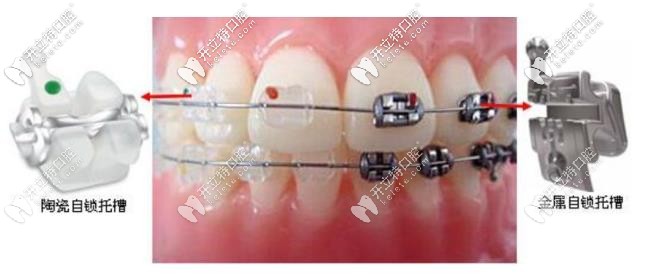 金屬自鎖和陶瓷自鎖的區(qū)別