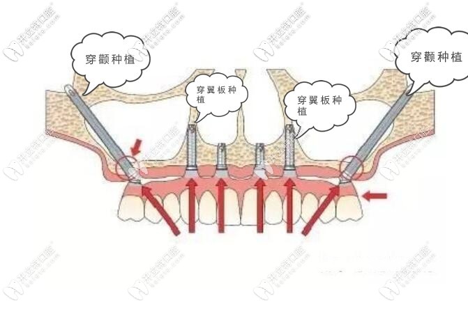 穿顴穿翼種植牙示意圖在此