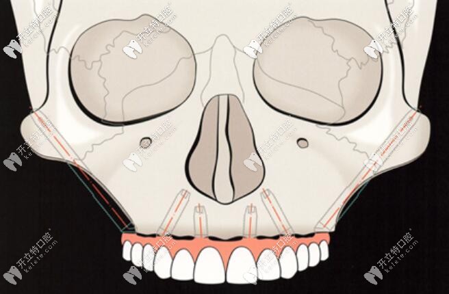 這是穿顴骨種植牙示意圖