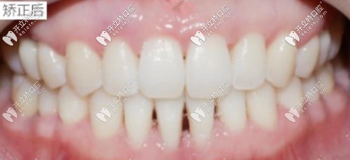 矯正后的牙齒