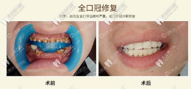 <!--<i data=20240703-sp></i>-->口腔牙齒磨耗全冠修復(fù)真人<span style=