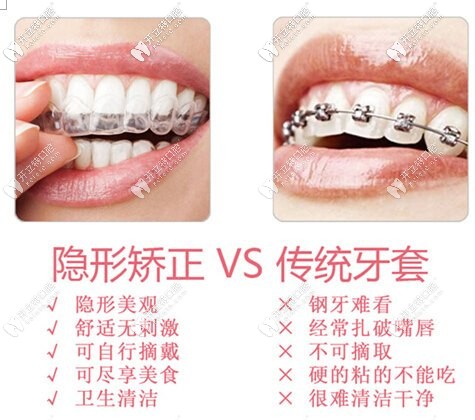 隱形牙套和鋼絲牙套對比