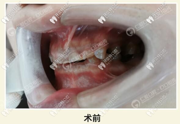 <!--<i data=20240703-sp></i>-->口腔全牙列過度磨耗