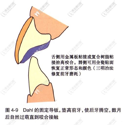 牙齒磨耗的治療方式之正畸