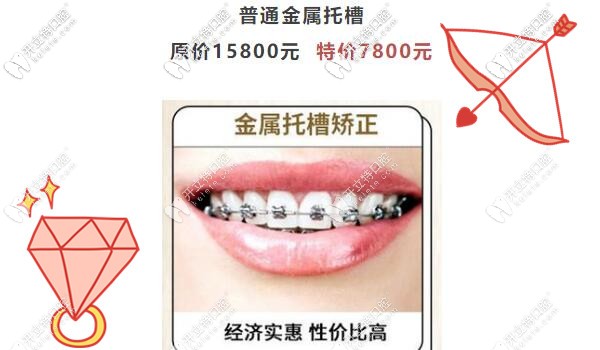 廣州圣貝傳統(tǒng)金屬托槽矯正才7800元啦,暑假正畸不造起來嗎？