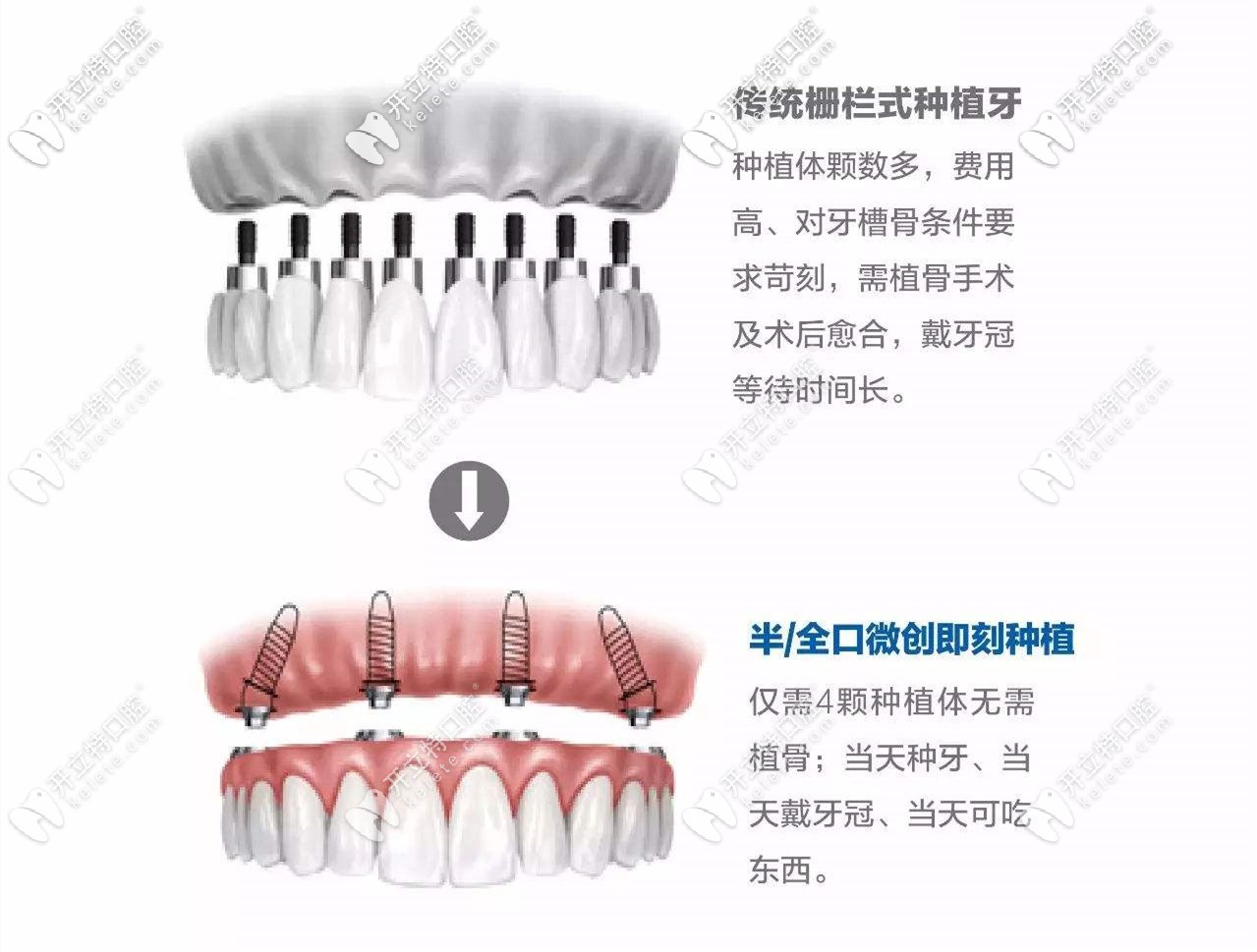 傳統(tǒng)種植牙和即刻種植牙區(qū)別