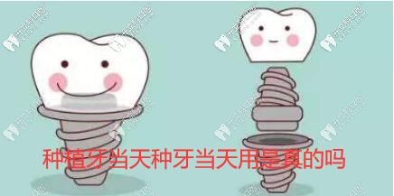 種植牙當天種當天用靠譜嗎