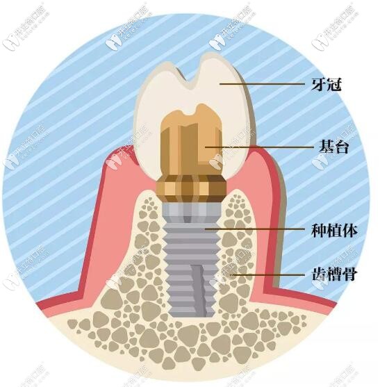即刻種植牙當(dāng)天種當(dāng)天用是真的嗎?先搞懂和即刻負重的區(qū)別
