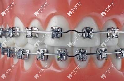 傳統(tǒng)金屬自鎖托槽圖片