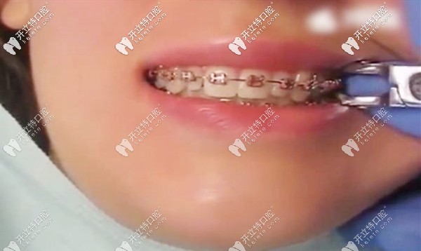 在廣州番禺區(qū)矯正多生牙的記錄